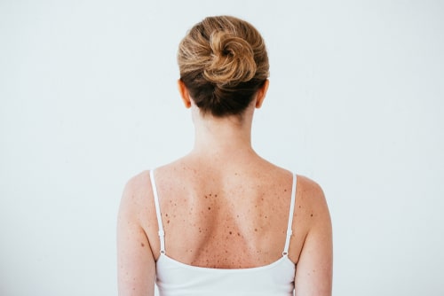 Benign Skin Lesions Treatment Austin TX