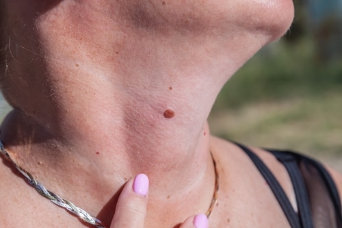 Mole & Birthmark Removal Austin TX