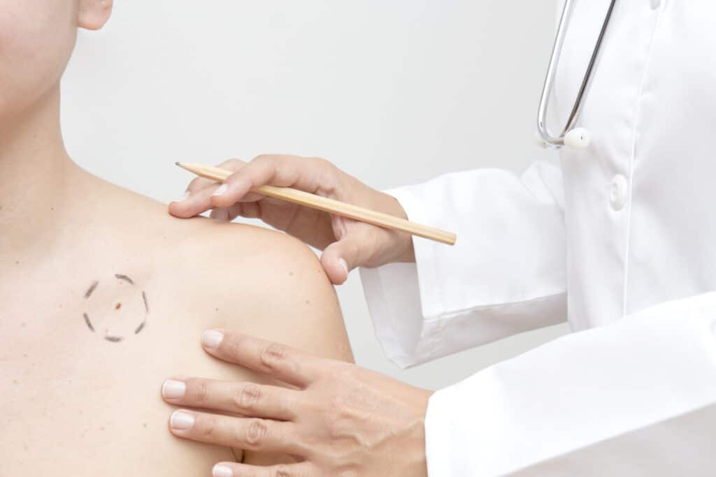 Doctor outlining a mole on patient’s skin during dermatology examination and mole evaluation procedure.