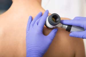Dermatologist examining basal cell carcinoma on a woman's back