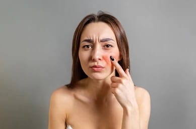 Woman with rosacea looking at her skin