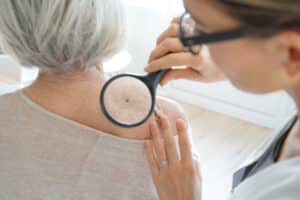 Dermatologist examining a patient's skin before Mohs surgery
